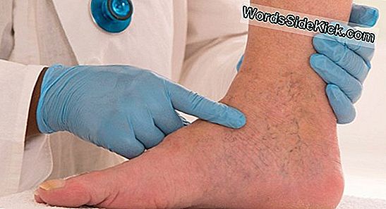 tratamentul revizuirilor de argila varicoza albastra)