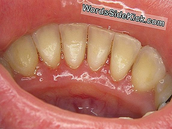 Parodontózis tünetei és kezelése - HáziPatika