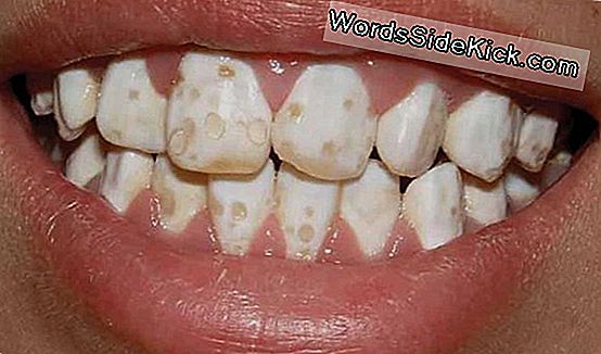 Mi okozhat belső elszíneződést a fogakon?