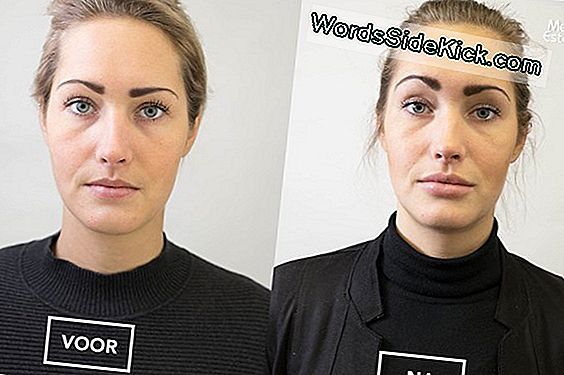 Botox: Gebruik En Bijwerkingen