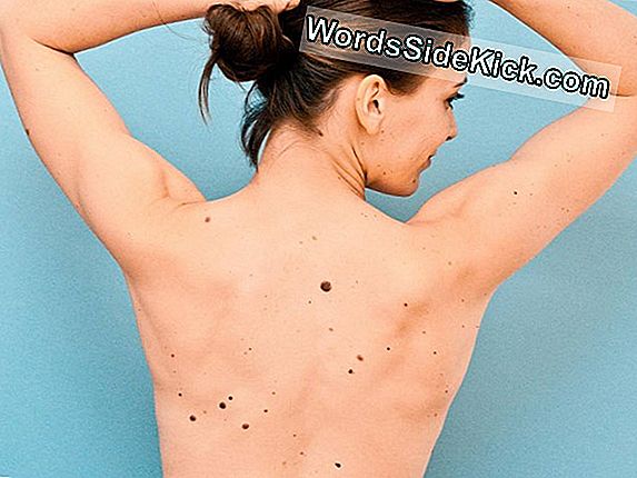 11 Moles On Your Arm May Signal Higher Melanoma Risk