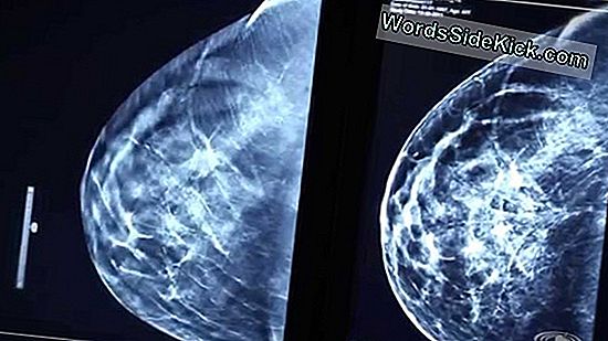 Pro-Mammogram Statistieken Tekenen Uitdaging