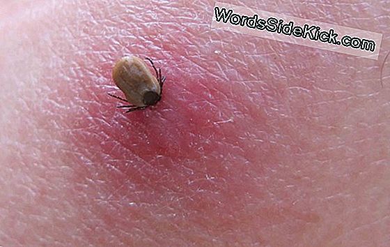 Tick ​​Bites: Symptomen & Behandeling