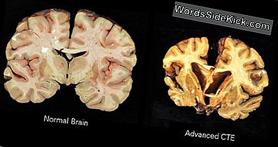 Chronische Traumatische Encefalopathie: Oorzaken, Symptomen En Behandeling