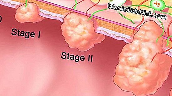 Een Kwart Van Colorectale Kankers Gekoppeld Aan Levensstijl