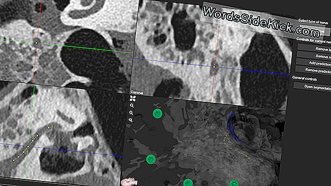 Robo First: Bot Assisteert Bij Tricky Cochleaire Implantaatchirurgie