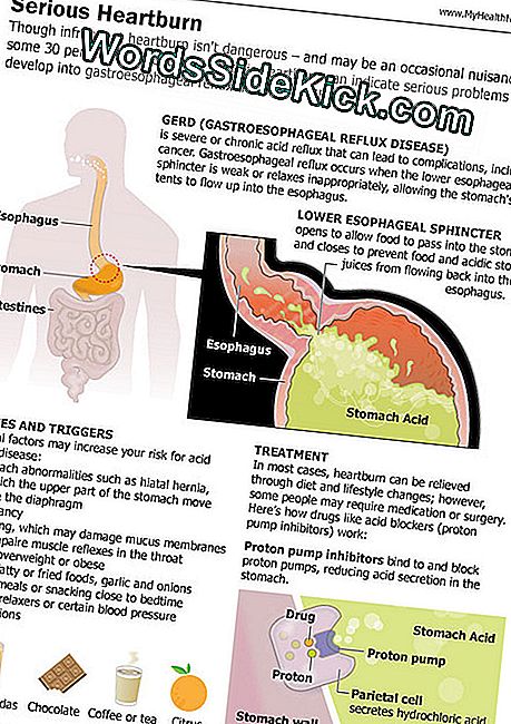 Acid reflux (GERD): simptomai ir gydymas: acid