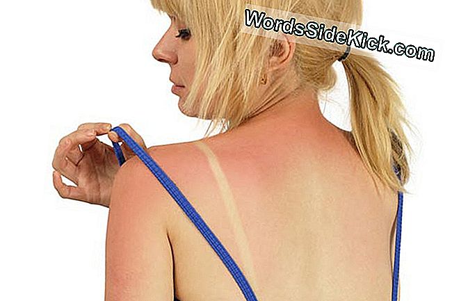 ศาสตร์แห่งฤดูร้อน: Sunburns เป็นสาเหตุอะไร?