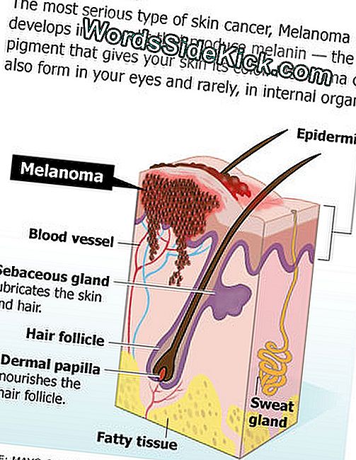 Melanom er den mest alvorlige type hudkræft. Lær mere om melanom hos MyHealthNewsDaily.com.