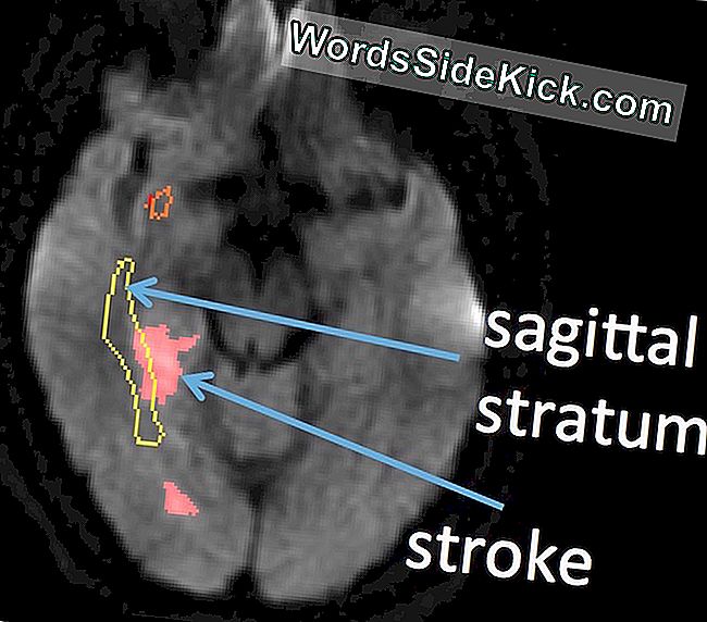 Mensen met schade aan de sagittale laag (gele contour) na een beroerte van de rechter hemisfeer hebben de neiging om problemen te hebben met het begrijpen van sarcasme.