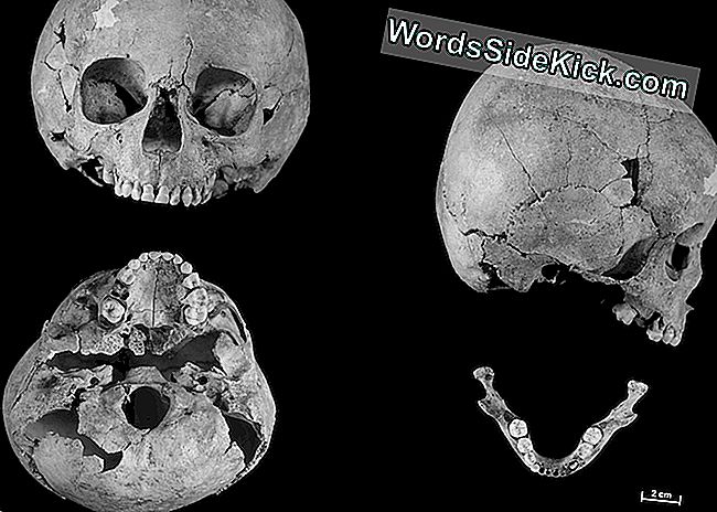 Der Schädel eines 5- bis 7-jährigen Kindes (hier abgebildet), das im mittelalterlichen Frankreich lebte, weist Anzeichen eines Down-Syndroms auf. Zum Beispiel war der Schädel kurz und breit und an der Basis abgeflacht.