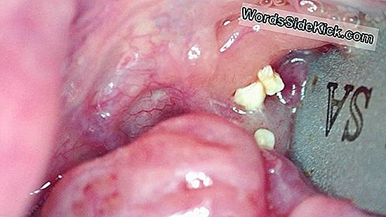 Tonsil Stones: Причини, Отстраняване И Предотвратяване