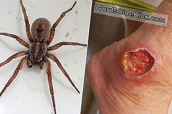 Pigens Brown Recluse Spider Bite Vender Ind I Åbent Sår