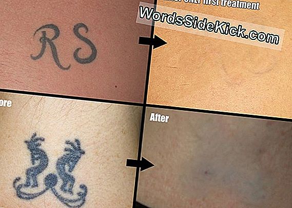 Tattoo-Fjernelse Laser Kunne Bekæmpe Acne Ar