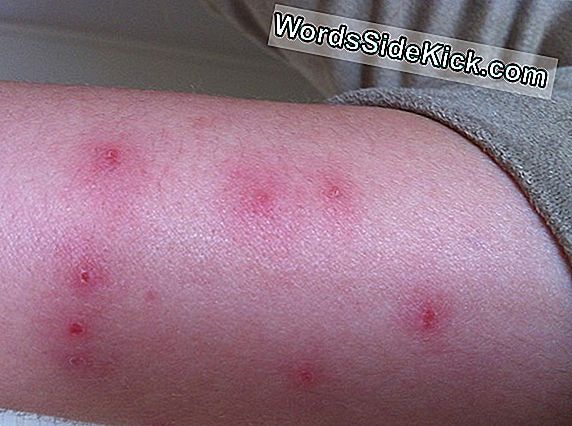 Wanzen: Fakten, Bisse Und Befall - 2024 | Gesundheit