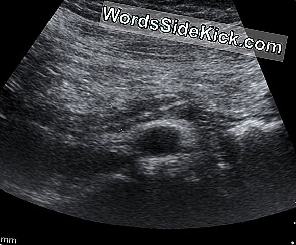 Apendicitis signos y sintomas