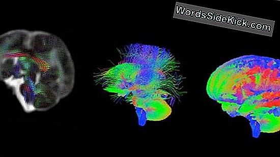 Los Escáneres Cerebrales Muestran Cómo Surge El Alzheimer