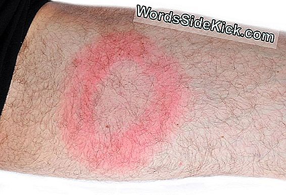 lyme+sintomas+y+tratamiento