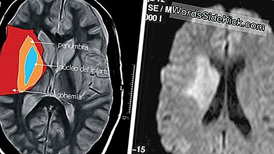 Para Evitar Un Accidente Cerebrovascular, Intente Aumentar Las Frutas Y Verduras 'Blancas'