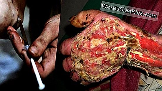 ¿Es Krokodil Realmente Una Droga Zombie Que Come Carne? - 2020