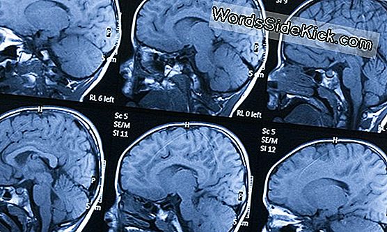 Brain Scans Näitab, Kuidas Alzheimeri Tõus Ilmneb