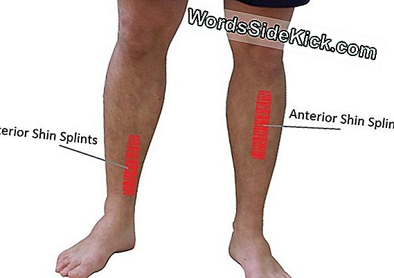 Shin Splints: Syyt, Hoito Ja Ehkäisy