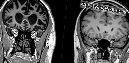 Tdah Versus Syndrome D'Alcoolisation Fœtale: Les Problèmes D'Apprentissage Des Enfants Diffèrent