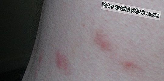 infezione da morso di zecca