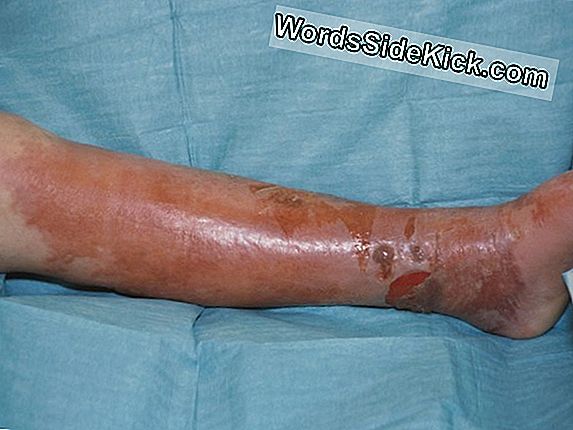 Wat Is Cellulitis?