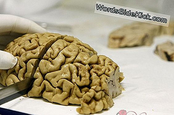 Ai Zou De Ziekte Van Alzheimer Twee Jaar Tevoren Kunnen Voorspellen
