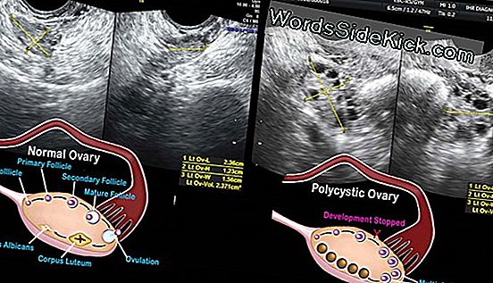 Polycystic Ovary Syndrome: Symptoms And Treatment