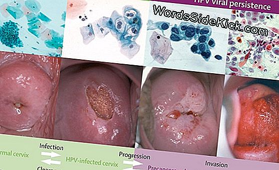 papiloma virus hpv sintomas