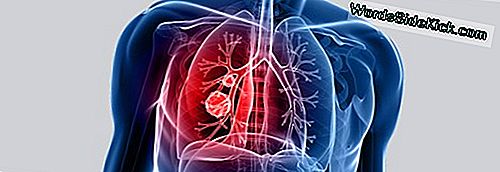 Bazı Akciğer Kanseri Hastaları Sigara Içer, Çalışma Bulur