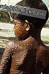 Kaip rodo viso kūno kūną dengiantis makulopapulinis išbėrimas, šis jaunas berniukas užsikrėtė raupomis. Nuotrauka daryta Bangladeše 1974 m.